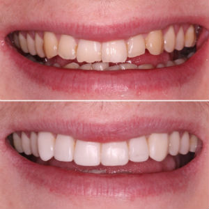 Before and after images of teeth whitening treatmetn at Bupa Dental Care.