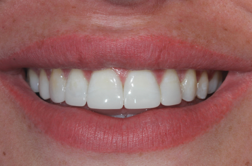 Patient Kelsey after Invisalign and whitening treatment.