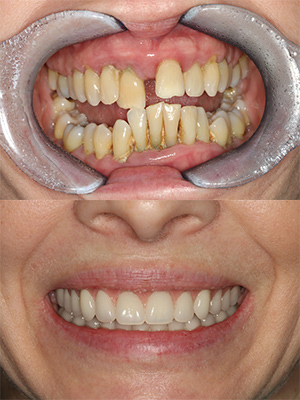 Crooked smile before smile in a day implant treatment was used to create straight smile