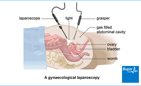 laparoscopy untuk trying to conceive