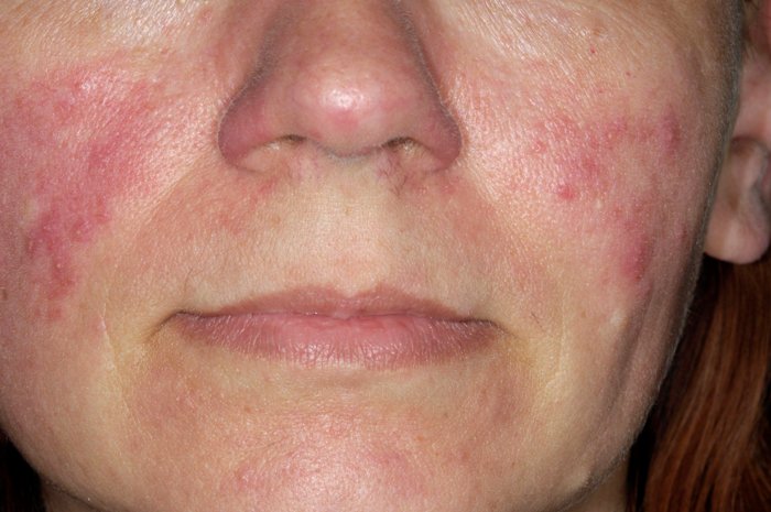 rosacea acne on cheeks