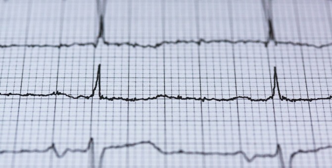 An electrocardiogram (ECG) reading
