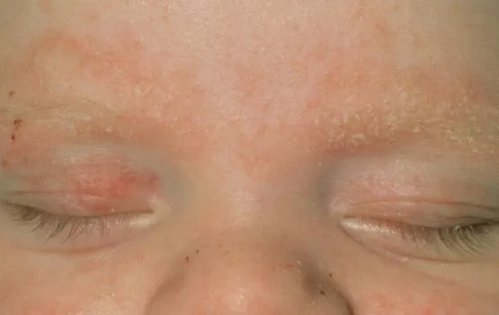 Photo showing seborrhoeic dermatitis on the face of a baby