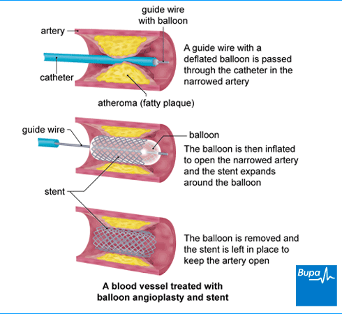Image showing a blood vessel treated with balloon angioplasty and stent Image showing a blood vessel treated with balloon angioplasty and stent