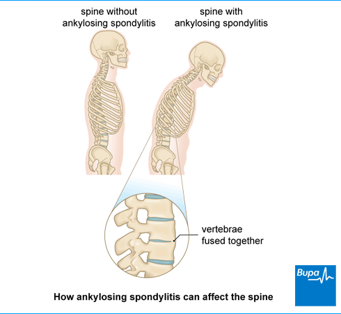 Image showing how ankylosing spondylitis can affect the spine Image showing how ankylosing spondylitis can affect the spine