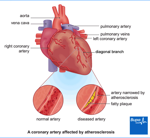 Image showing a coronary artery affected by atherosclerosis