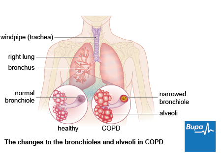 Image showing the changes to the bronchioles and alveoli in COPD