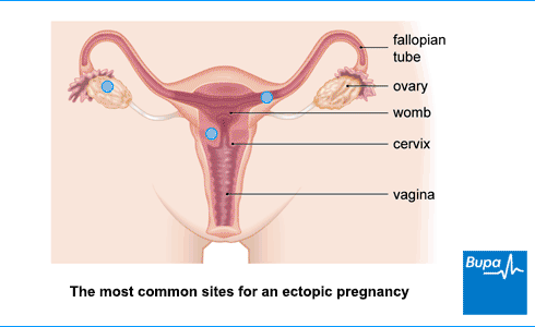 An image showing the most common sites for an ectopic pregnancy