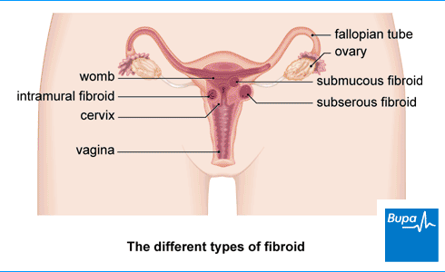 Image showing the different types of fibroid Image showing the different types of fibroid