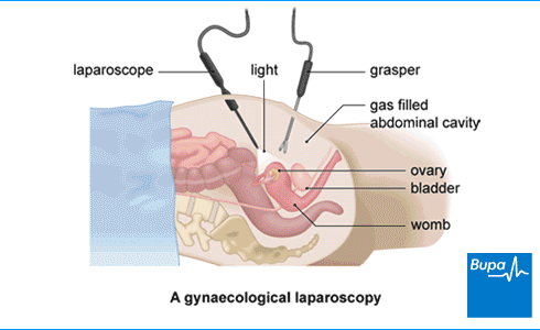 An image showing a gynaecological laparoscopy An image showing a gynaecological laparoscopy