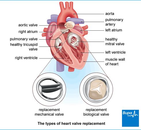 An image showing the types of heart valve replacement