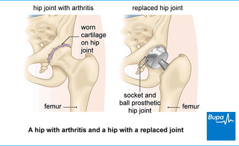 An image showing a hip with arthritis and a hip with a replaced joint