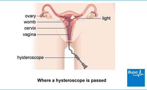 An image showing where a hysteroscope is passed An image showing where a hysteroscope is passed