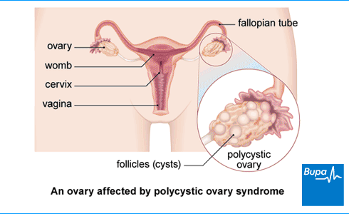 An image showing an ovary affected by polycystic ovary syndrome