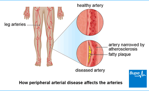 An image showing how peripheral arterial disease affects the arteries An image showing how peripheral arterial disease affects the arteries