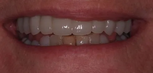 Straight, bright teeth following smile in a day treatment by Peter Sanders at Dental Confidence, part of Bupa