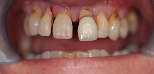 Gappy, unhealthy, protruding teeth before smile in a day treatment at Dental Confidence, part of Bupa